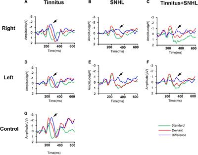 Sensorineural Hearing Loss Affects Functional Connectivity of the Auditory Cortex, Parahippocampal Gyrus and Inferior Prefrontal Gyrus in Tinnitus Patients